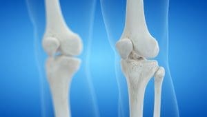 HEALTH TRENDS: Dairy & Bone Health